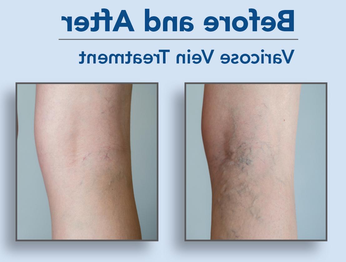 before and after varicose vein treatment